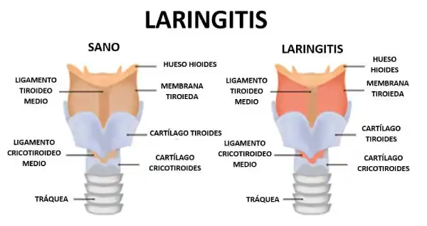 Contaminación-Del-Aire-Laringitis