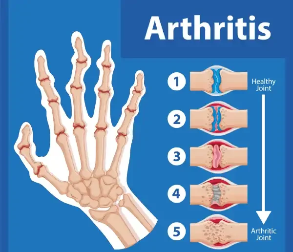 Artritis-Metales-Pesados