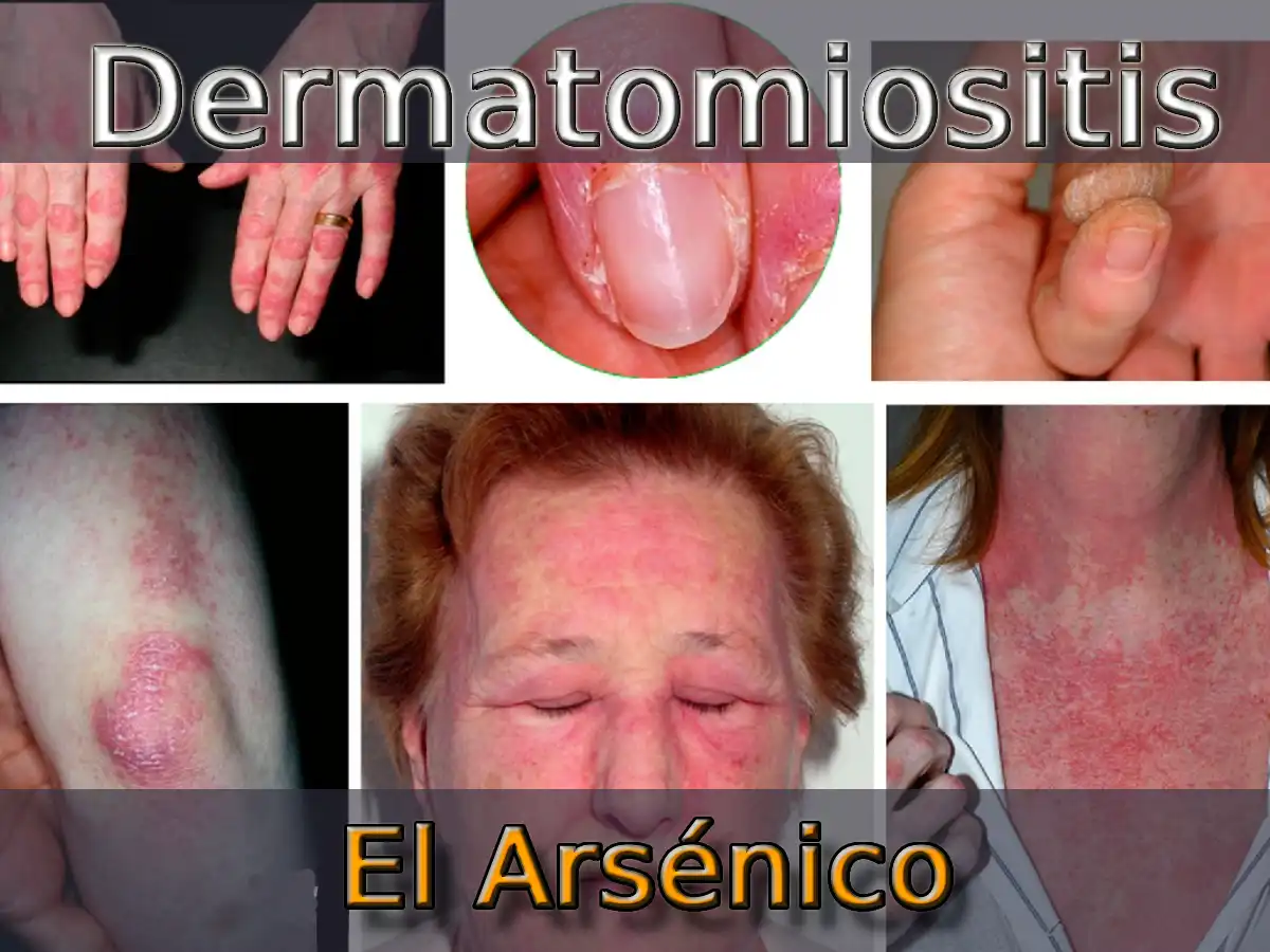 Dermatomiositis Y El Arsénico