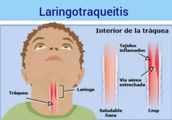 Laringotraqueitis