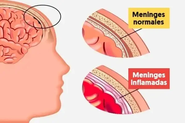 Meningitis-Riesgos