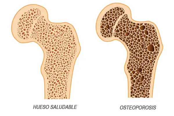 Osteoporosis-Metales-Pesados