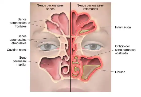 Sinusitis