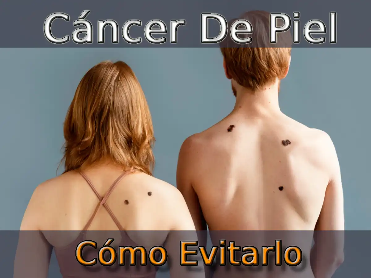 Cáncer De Piel Y Cómo Evitarlo